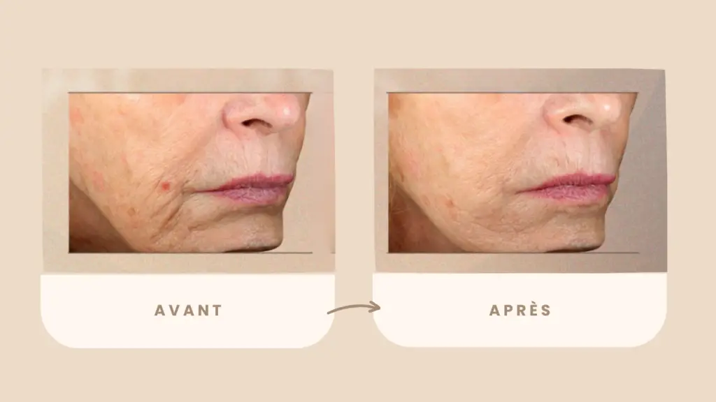 microneedling avant apres