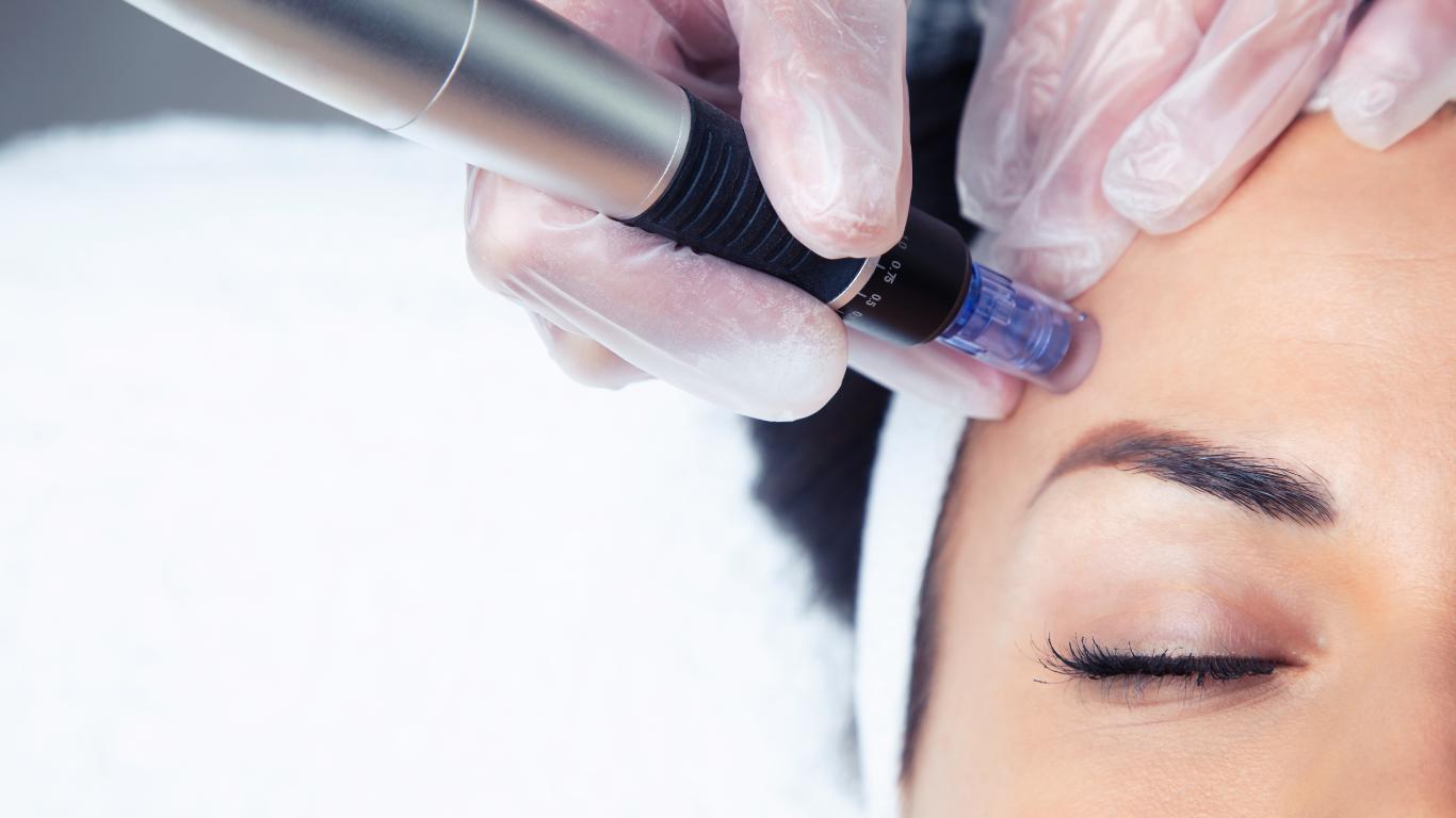 microneedling avant après