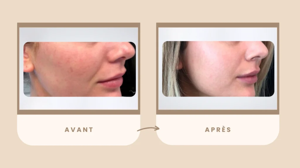 microneedling avant après