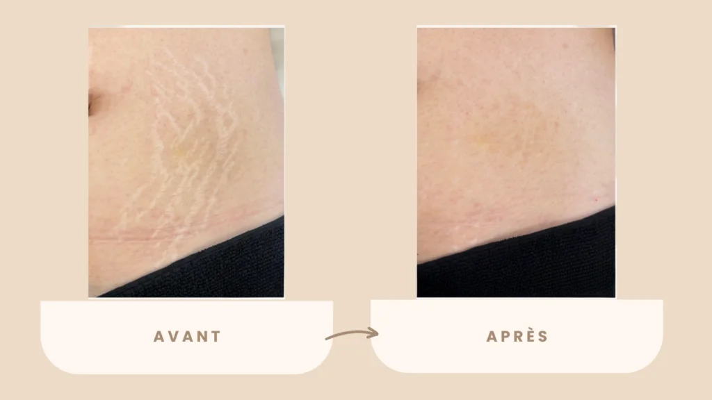 Microneedling vergetures avant après