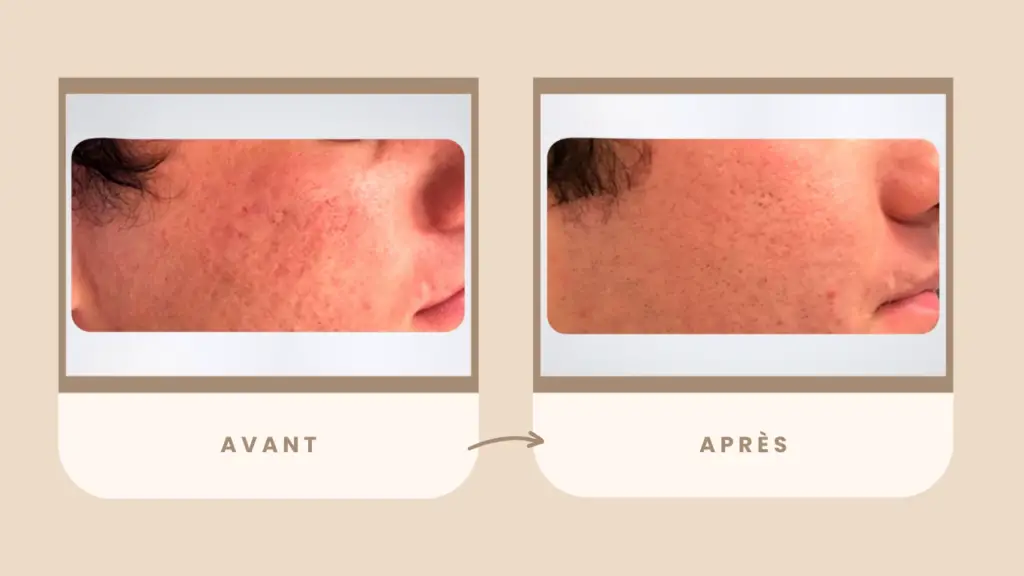 microneedling avant/après