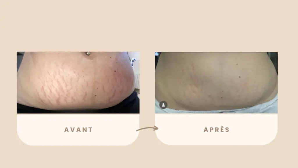 Microneedling vergetures avant après ventre