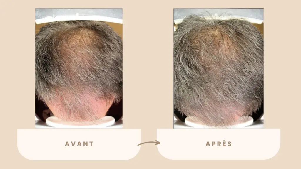 Microneedling cheveux avant après